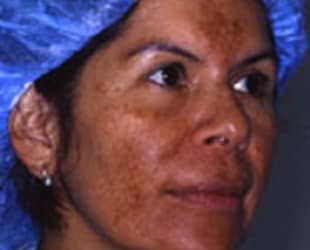 skin rejuvenation treatment before and after | Skin and Laser Surgery Center of New England