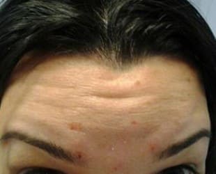 Botox