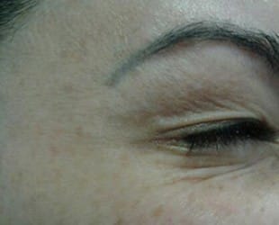 Botox / Dysport
