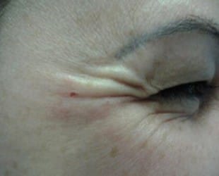 Botox / Dysport