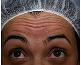 Botox / Dysport