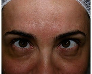 Botox / Dysport