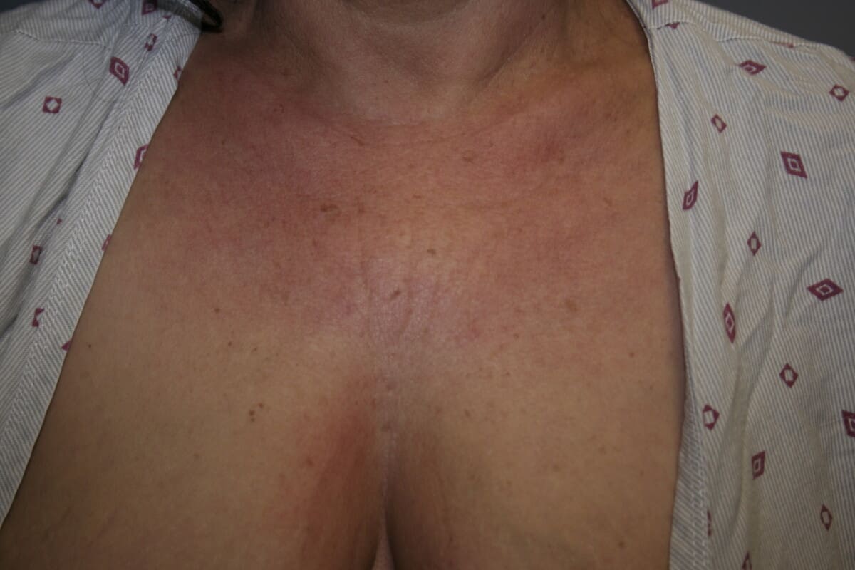 Botox Before and 2 Weeks After