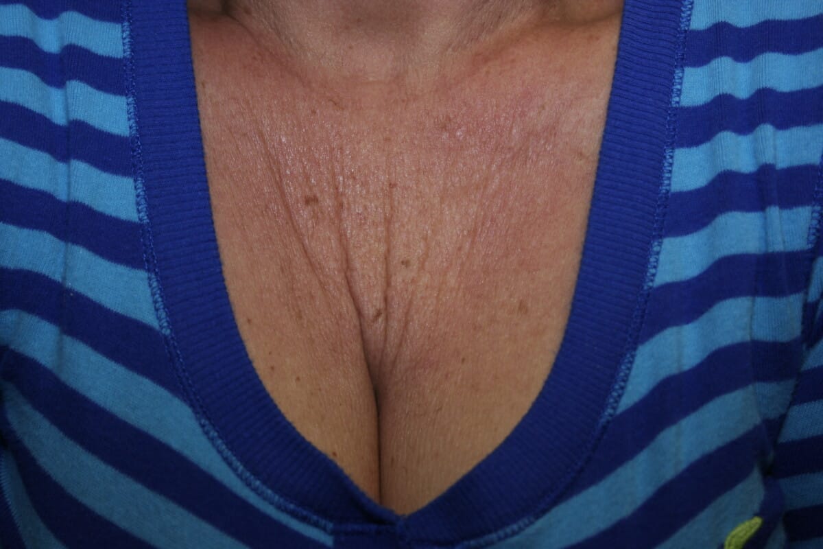 Botox Before and 2 Weeks After