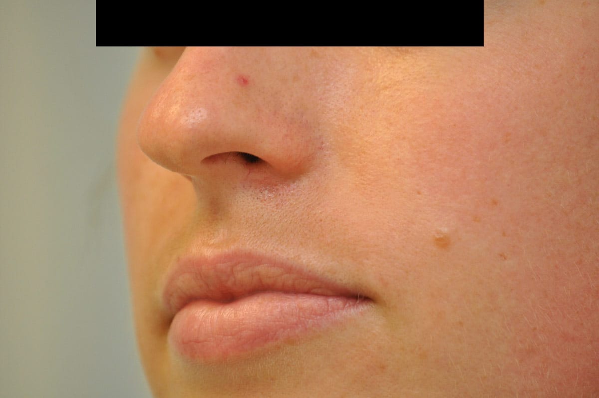 Mole / Growth Removal Archives Skin & Laser Surgery Center of New England