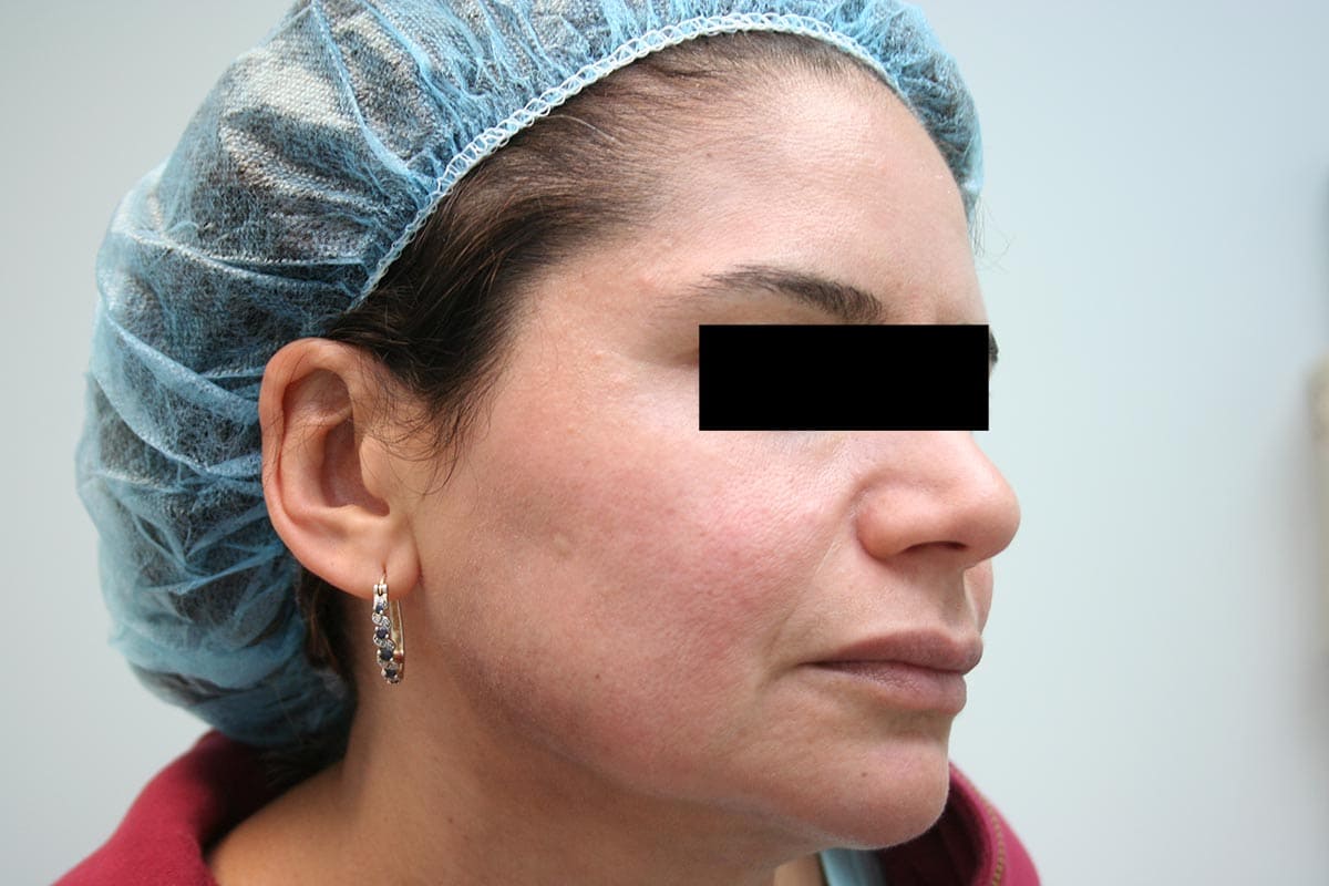 Melasma / Pregnancy Mask Skin & Laser Surgery Center of New England