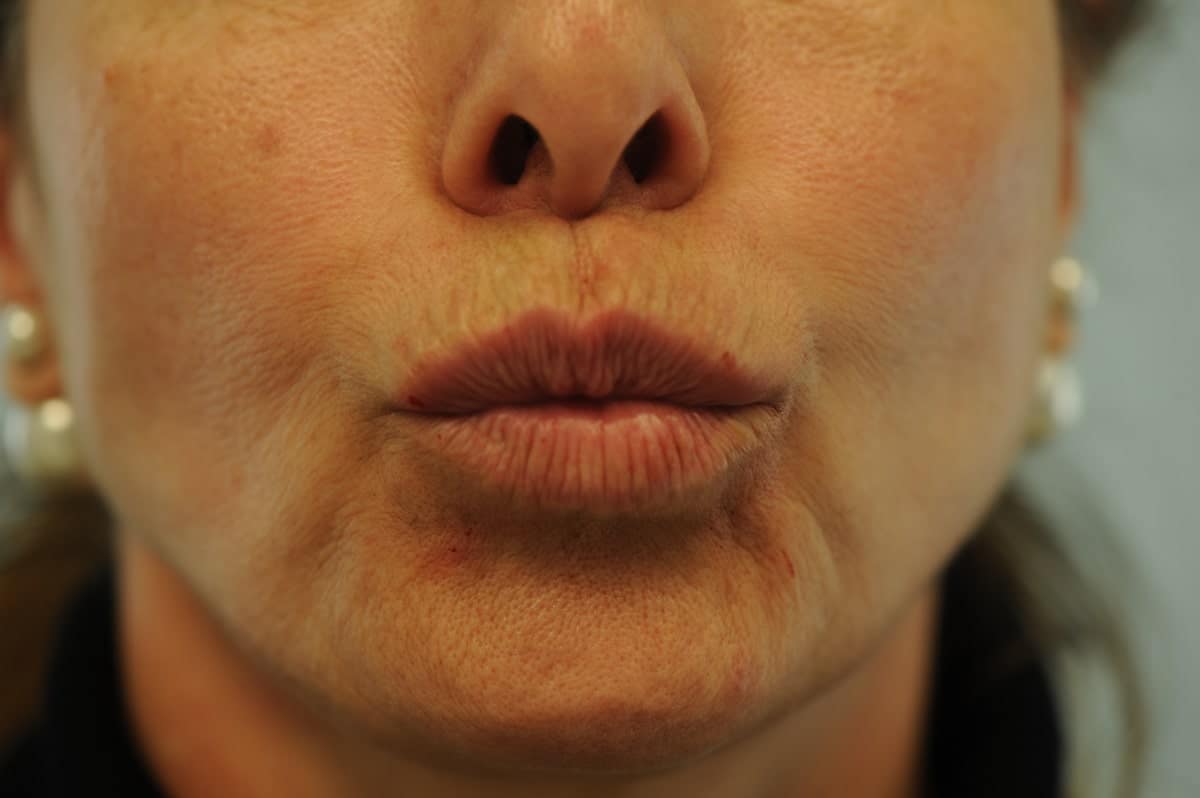 Before and After Perioral (Smoker) Lines Skin & Laser Surgery Center