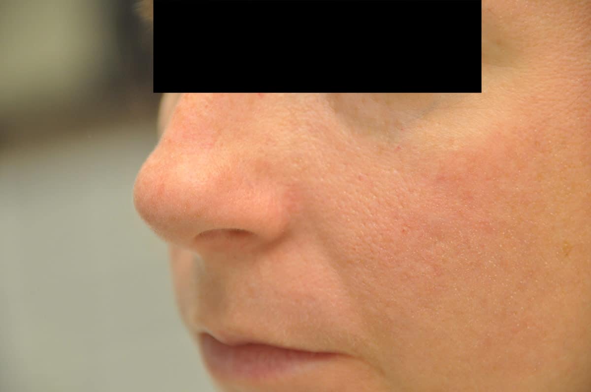 Mole / Growth Removal Archives Skin & Laser Surgery Center of New England